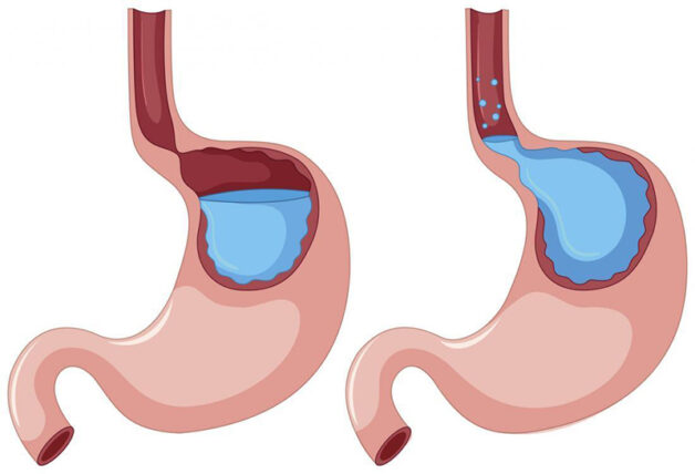 Gastroesophageal Reflux Disease (GERD) - Symptoms and Causes