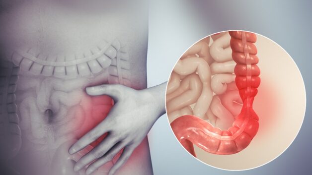Understanding Irritable Bowel Syndrome: Symptoms, Causes, and Diagnosis