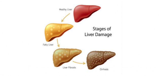 Dangerous Complications of Fatty Liver Disease