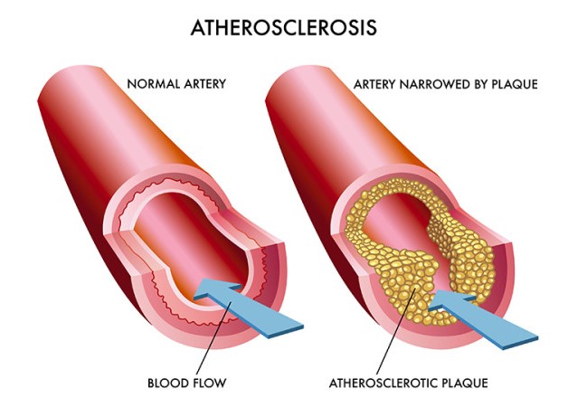 An Overview of Atherosclerosis