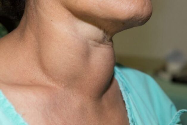 Common Types of Thyroid Nodules