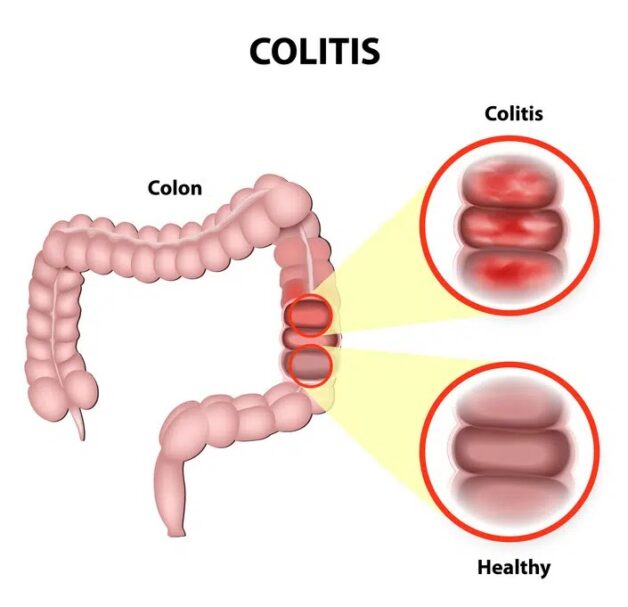 Colitis Overview
