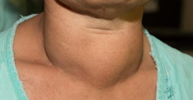 Goiter: Causes and Symptoms