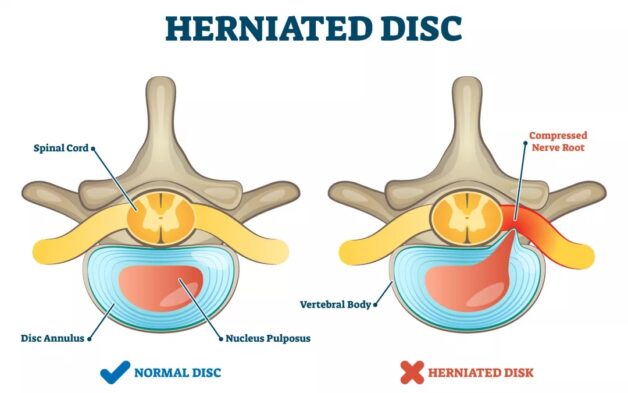Disc Herniation in Young Individuals
