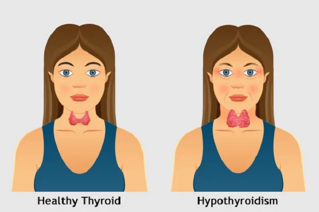 Hypothyroidism: Insights into Causes, Recognition and Treatment
