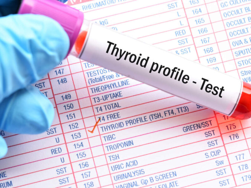 Diagnosis and Treatment of Hypothyroidism