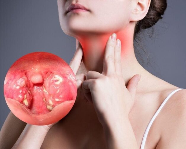 Signs of Tonsillitis