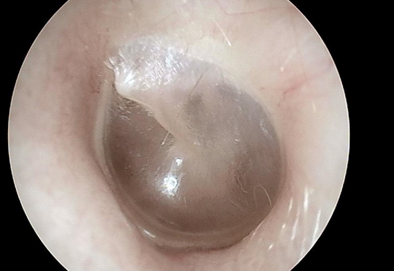 Understanding Middle Ear Infections in Children