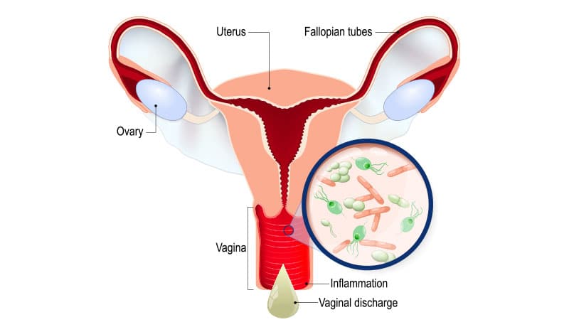 Main Causes of Vaginal Infections