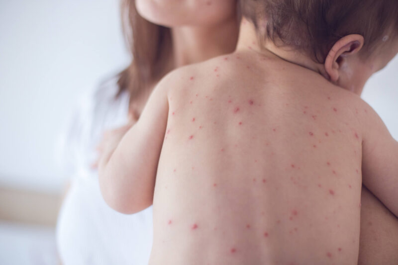 Recognizing Signs of Chickenpox in Children