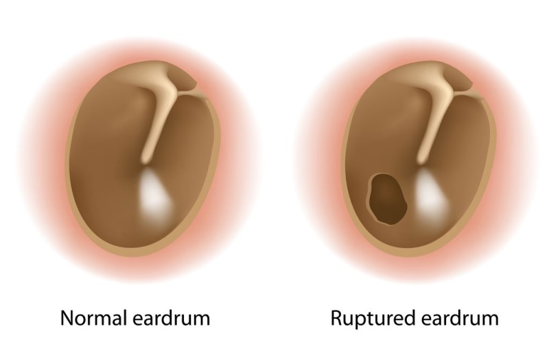 Dangerous Complications of Middle Ear Infection in Children