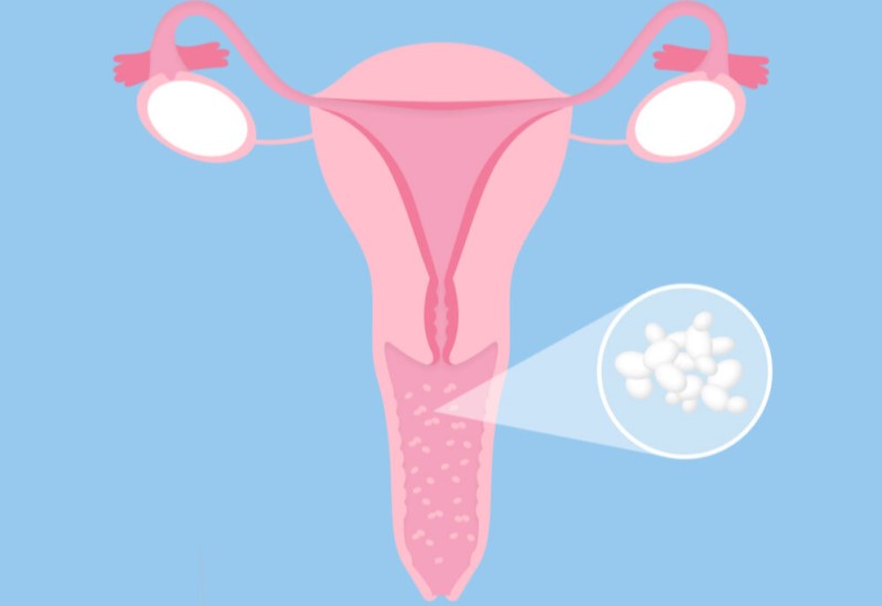 What is a Vaginal Yeast Infection?
