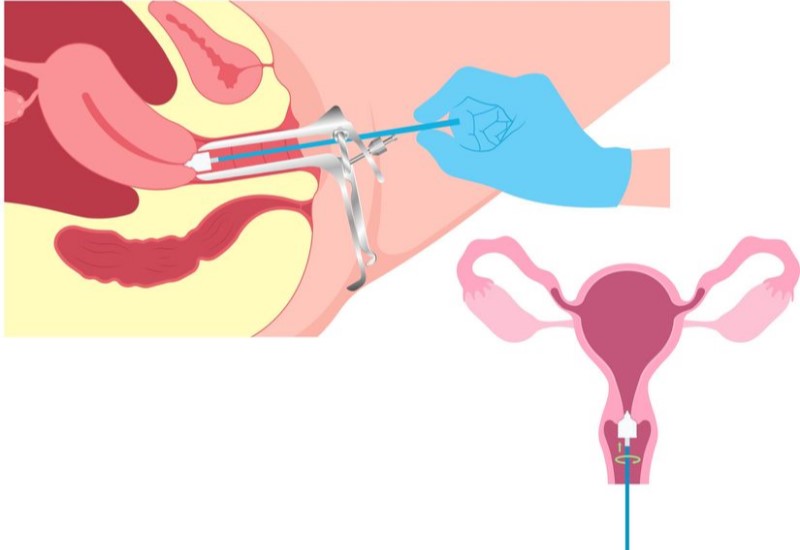 What is PAP Smear for Cervical Cancer Screening?