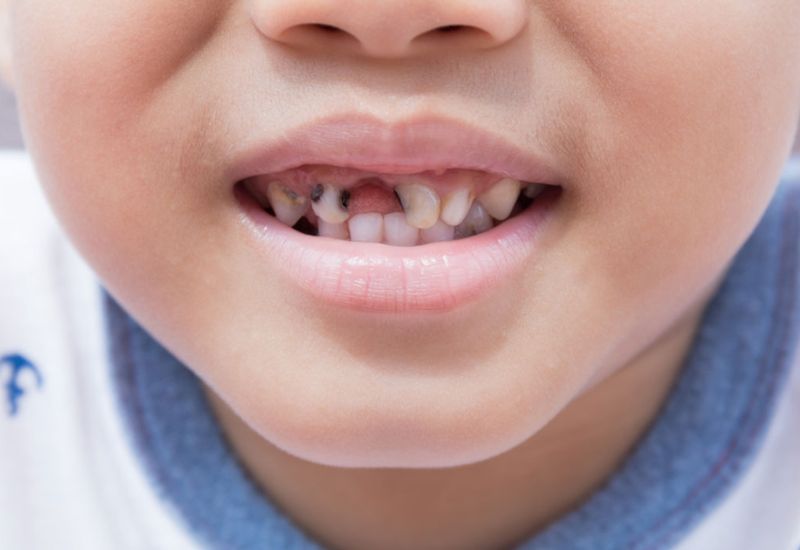 Causes of High Rates of Cavities in Baby Teeth