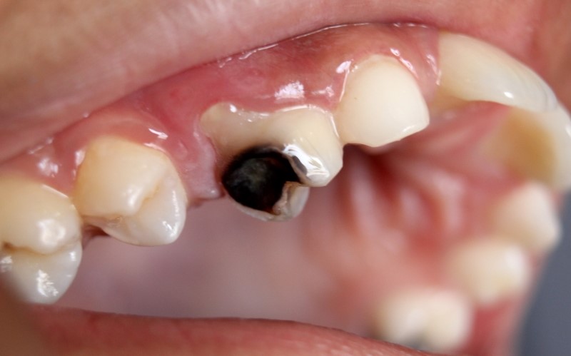 Is Tooth Decay a Serious Condition?