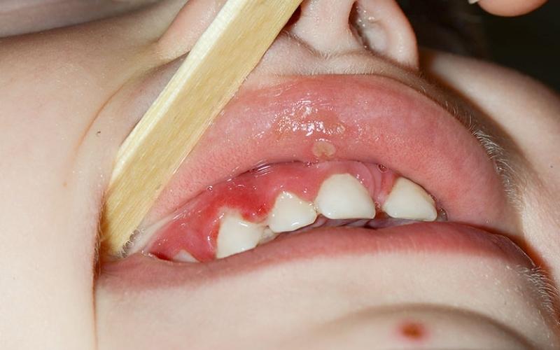 What is Gingivitis in Children?