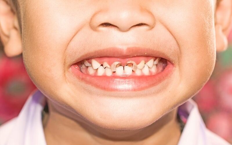 Factors Contributing to Cavities on Front Teeth