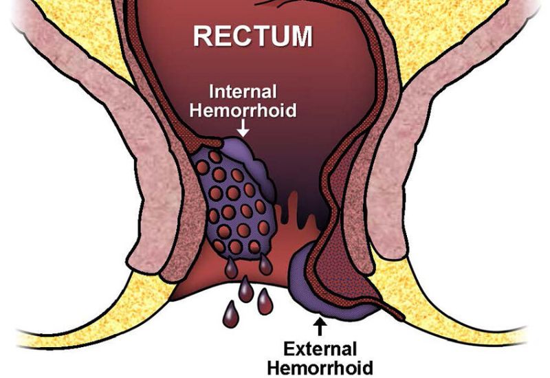What are the characteristics of Hemorrhoids and Rectal Cancer?