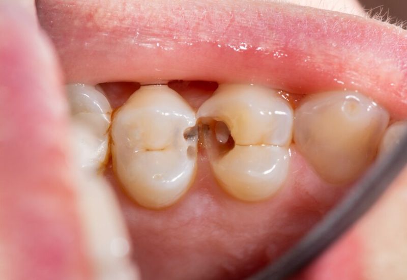 Causes of Molar Cavities in Children