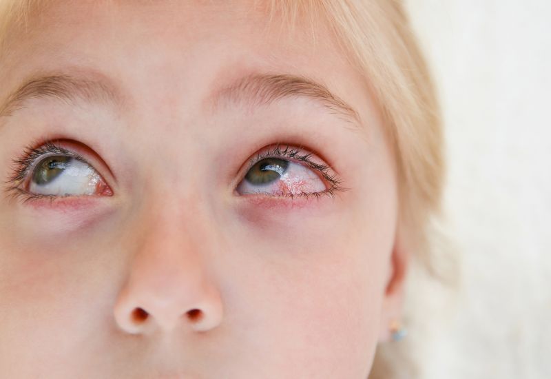 Symptoms of Pink Eye