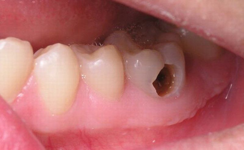 Process and Symptoms of Tooth Decay Reaching the Pulp