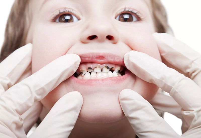 What is Tooth Decay Reaching the Pulp?