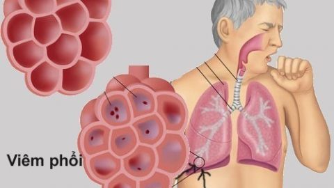 Bệnh viêm phổi ở người lớn triệu chứng của bệnh