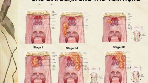 Ung thư vòm họng giai đoạn cuối sống được bao lâu?