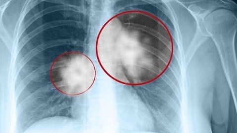 Chụp X-quang có phát hiện ung thư phổi không?