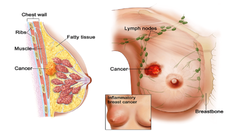 The examination package for female to detect early breast cancer