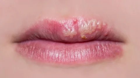 Cold Sores