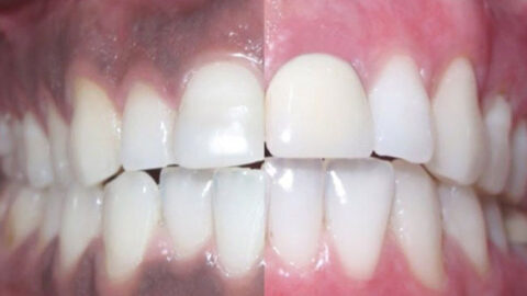 What does your Dark Gums mean?