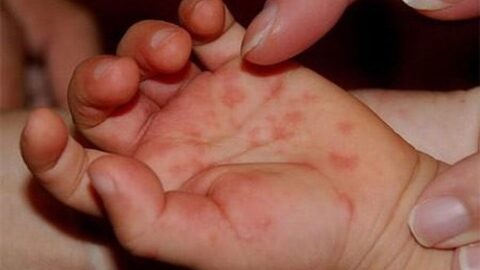 Hand, Foot, and Mouth Disease (HFMD)