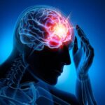 Stroke: What it is and Treatment