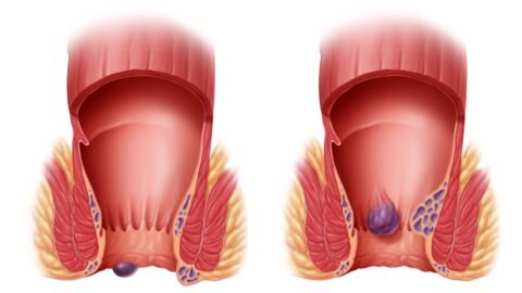 Unveiling the Enigma: What You Need to Know About Hemorrhoids