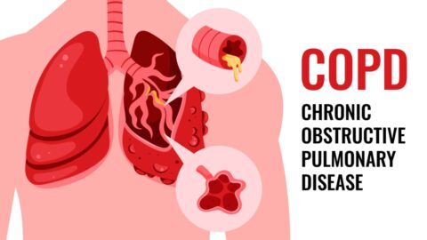 Comprehensive Overview of Chronic Obstructive Pulmonary Disease (COPD)