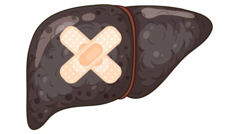 Clinical Symptoms of Liver Fibrosis Across Stages