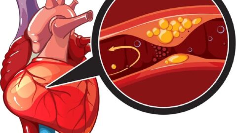 Causes and Implications of Coronary Artery Disease