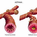 Identifying Symptoms and Treating Asthma