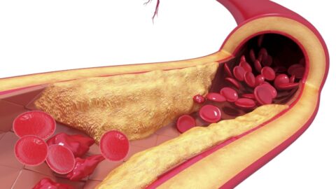 Symptoms and Consequences of Atherosclerosis