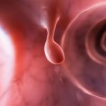 Colorectal Polyps – Understanding, Causes, and Management