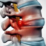Disc Herniation in Young Individuals and Prevention Measures