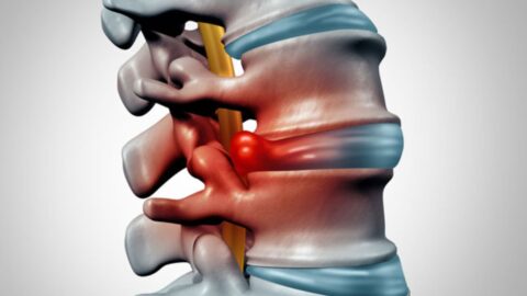 Disc Herniation in Young Individuals and Prevention Measures