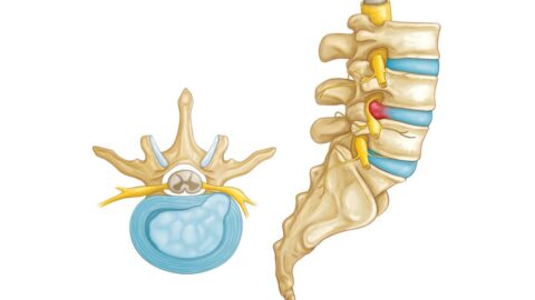 Overview of Lumbar Disc Herniation