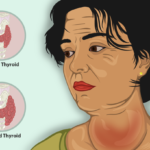 Goiter: Causes and Symptoms