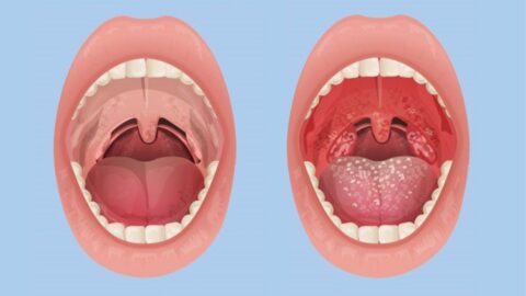 Comprehensive Information on Tonsillitis