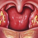 Recognizing Signs of Tonsillitis
