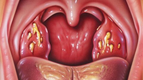 Recognizing Signs of Tonsillitis