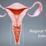 Understanding the Causes and Prevention Strategies of Vaginal Yeast Infections