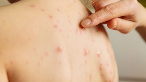 Prevention of Chickenpox in Children